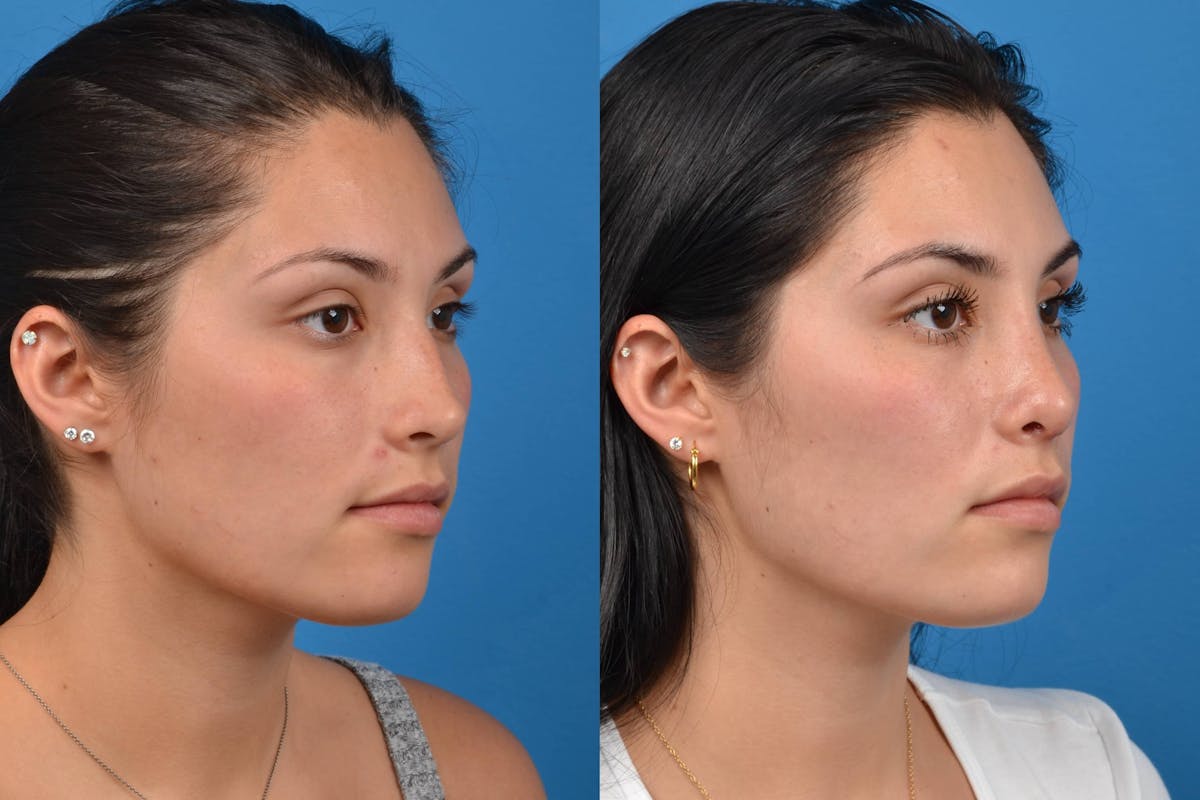Rhinoplasty Before & After Gallery - Patient 122406554 - Image 2