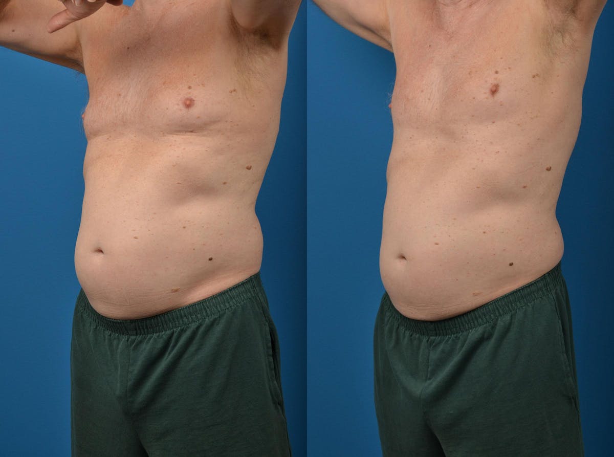 SculpSure Body Contouring Before & After Gallery - Patient 122406553 - Image 4