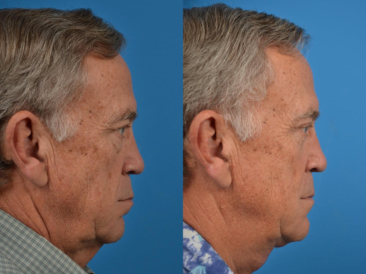 Profile Neck Lift Before & After Gallery - Patient 122406555 - Image 3