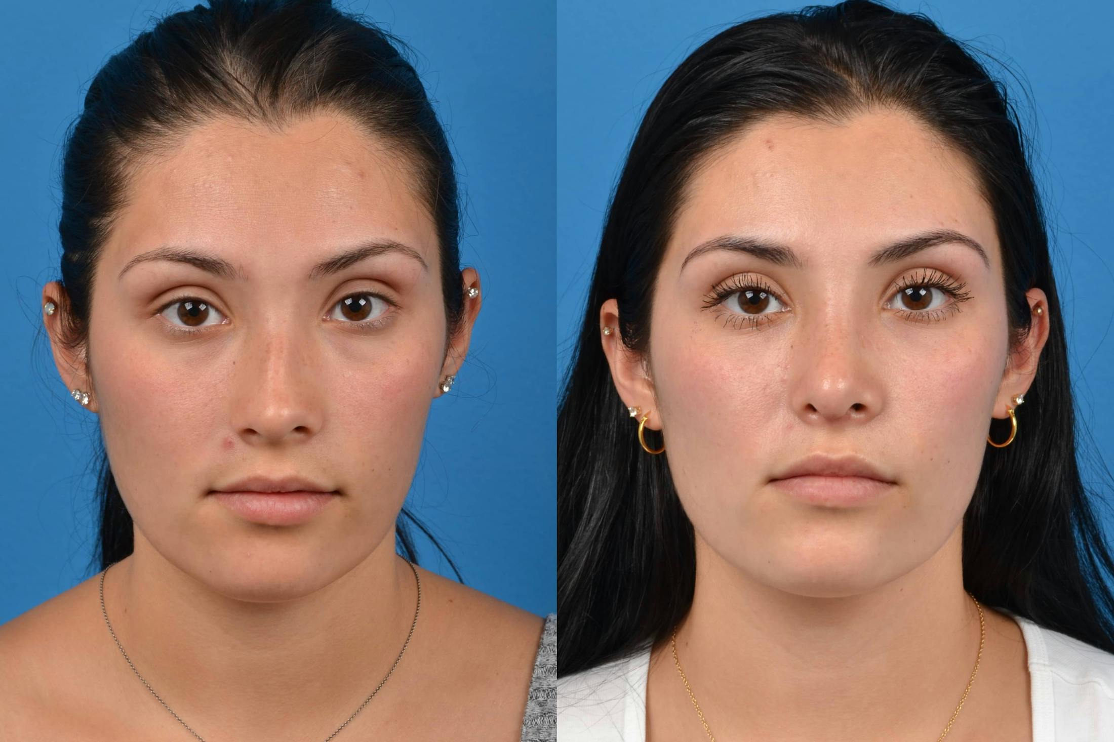 Rhinoplasty Before & After Gallery - Patient 122406554 - Image 3