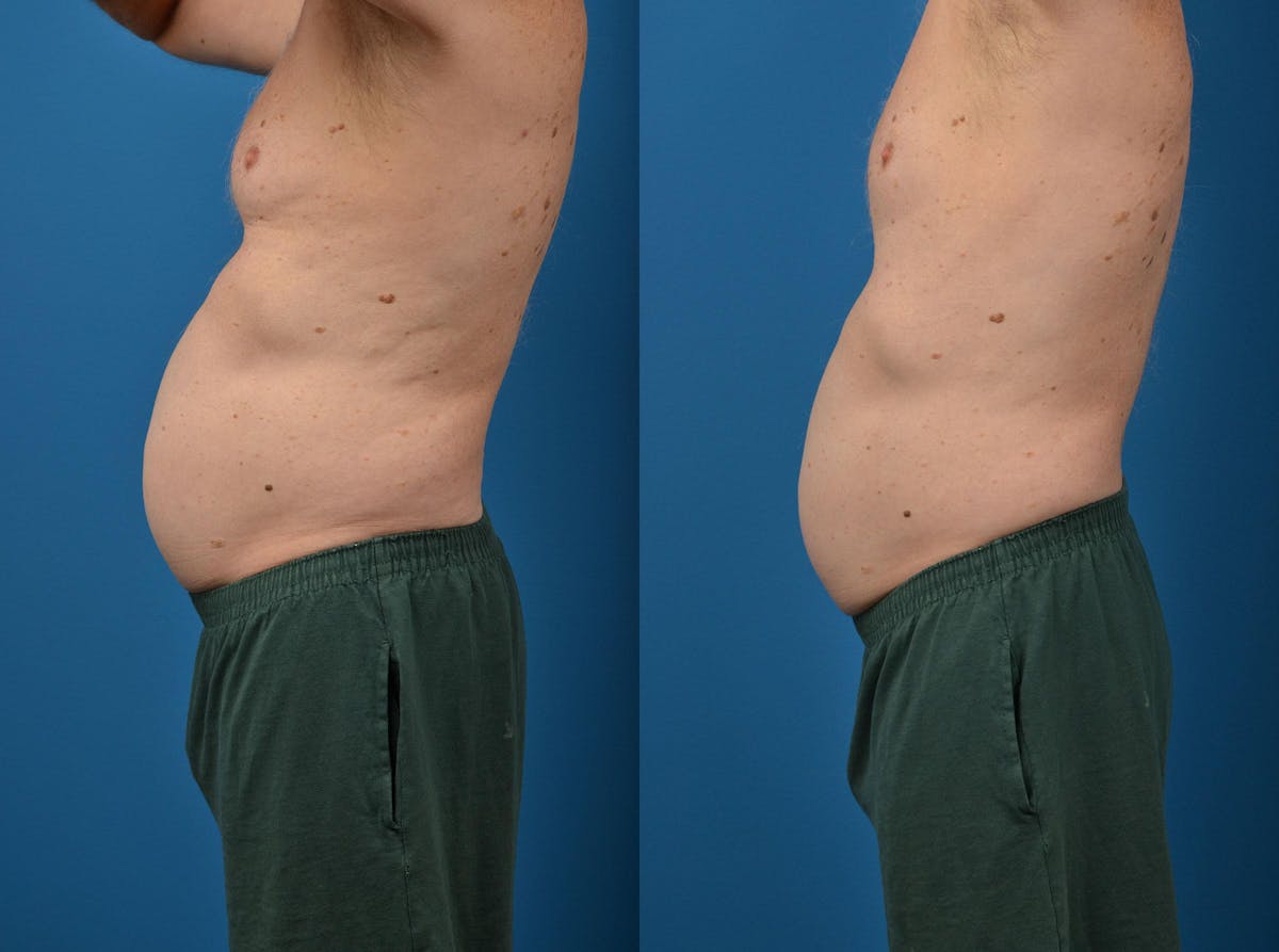SculpSure Body Contouring Before & After Gallery - Patient 122406553 - Image 5