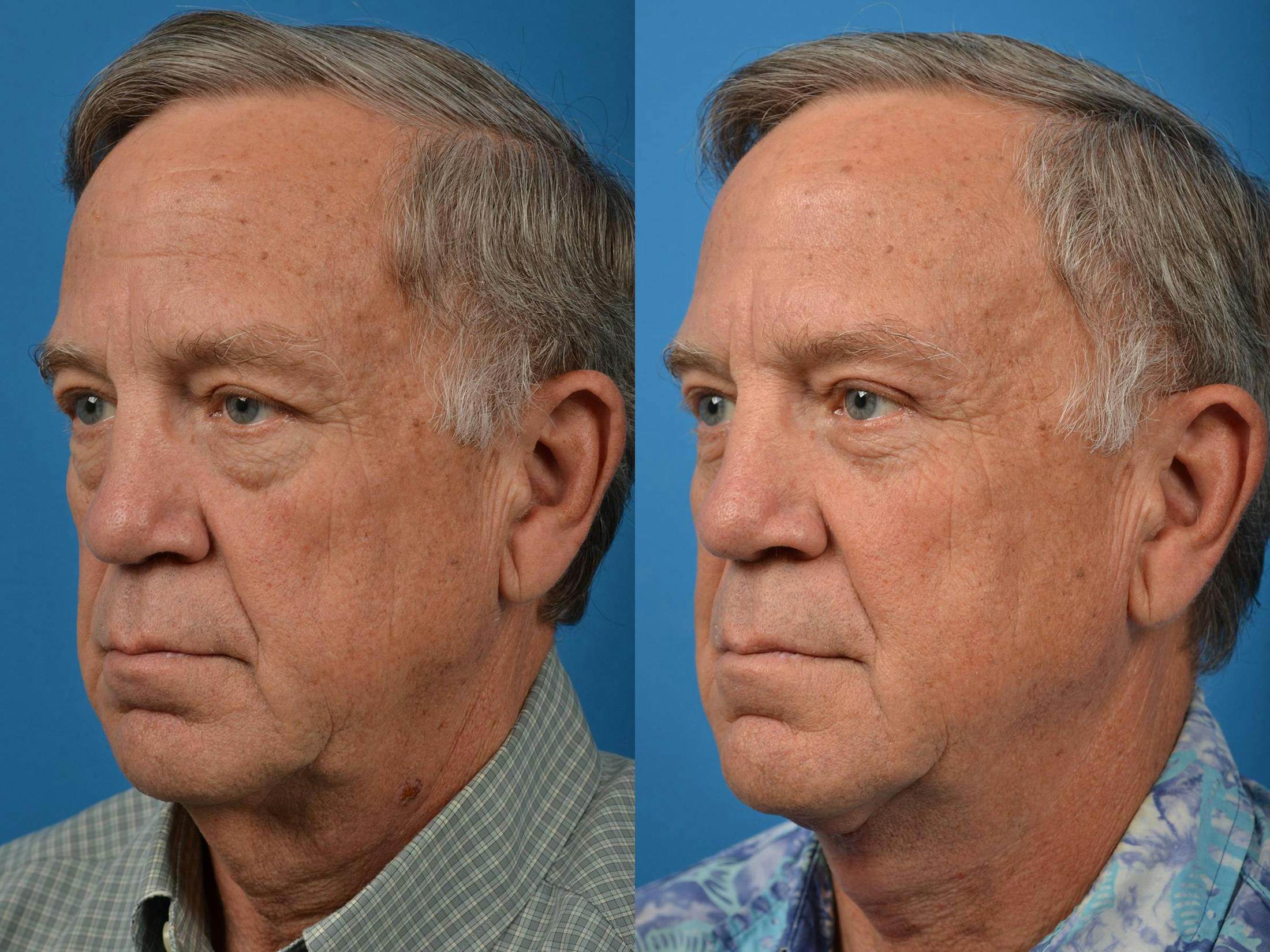 Profile Neck Lift Before & After Gallery - Patient 122406555 - Image 4