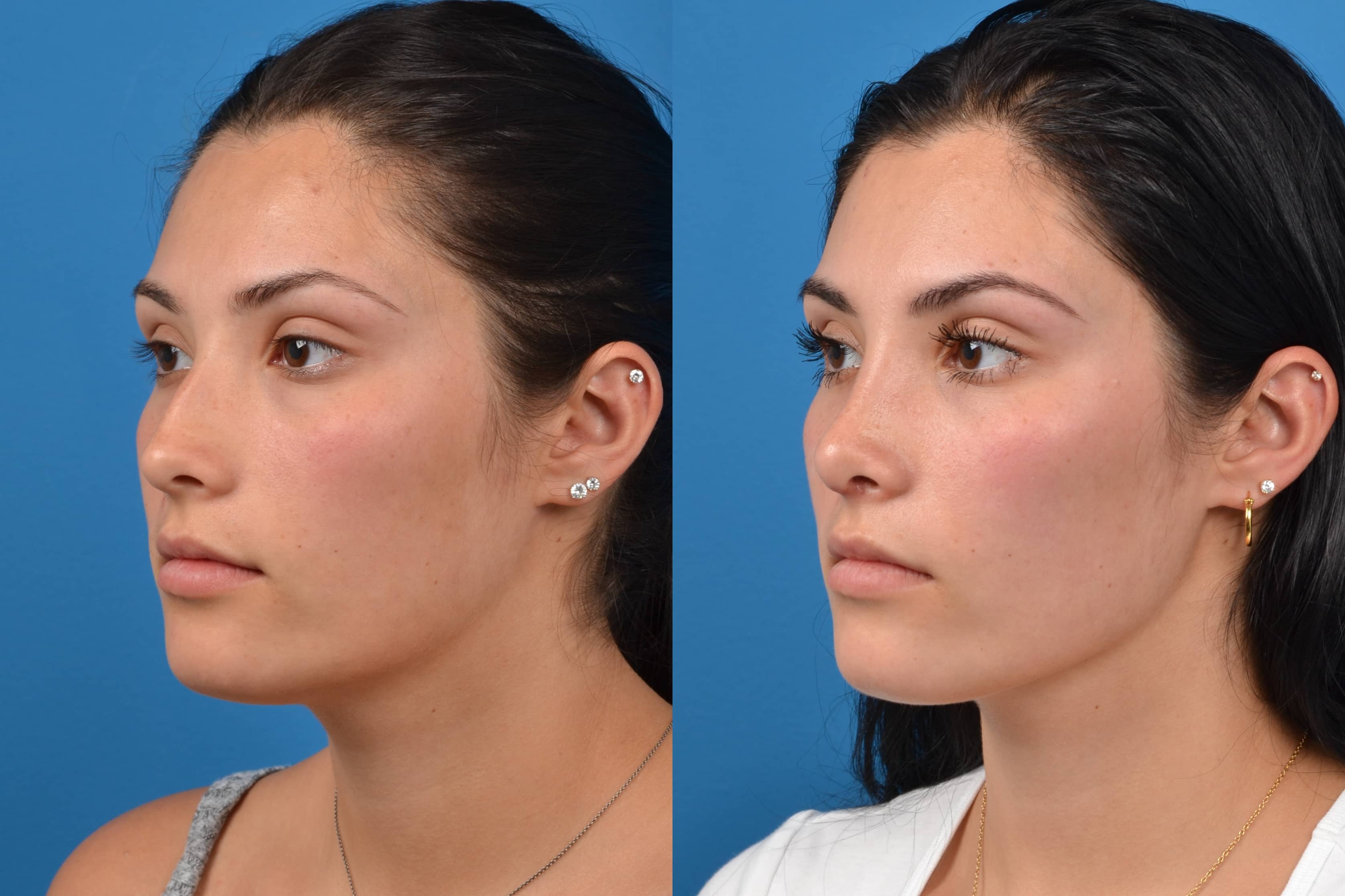 Rhinoplasty Before & After Gallery - Patient 122406554 - Image 4
