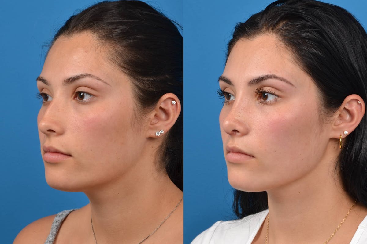 Rhinoplasty Before & After Gallery - Patient 122406554 - Image 4
