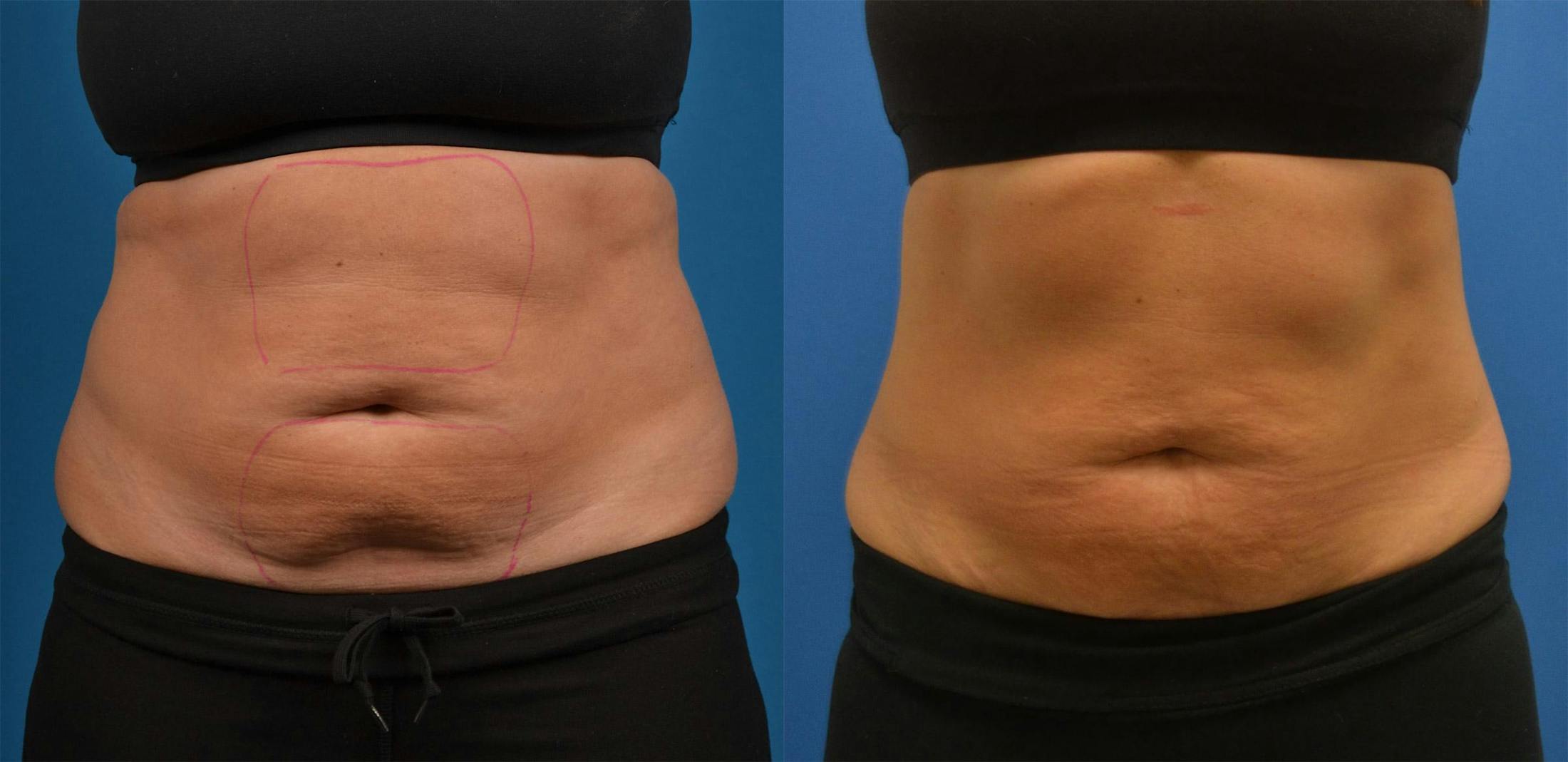 SculpSure Body Contouring Gallery - Patient 122406556 - Image 1
