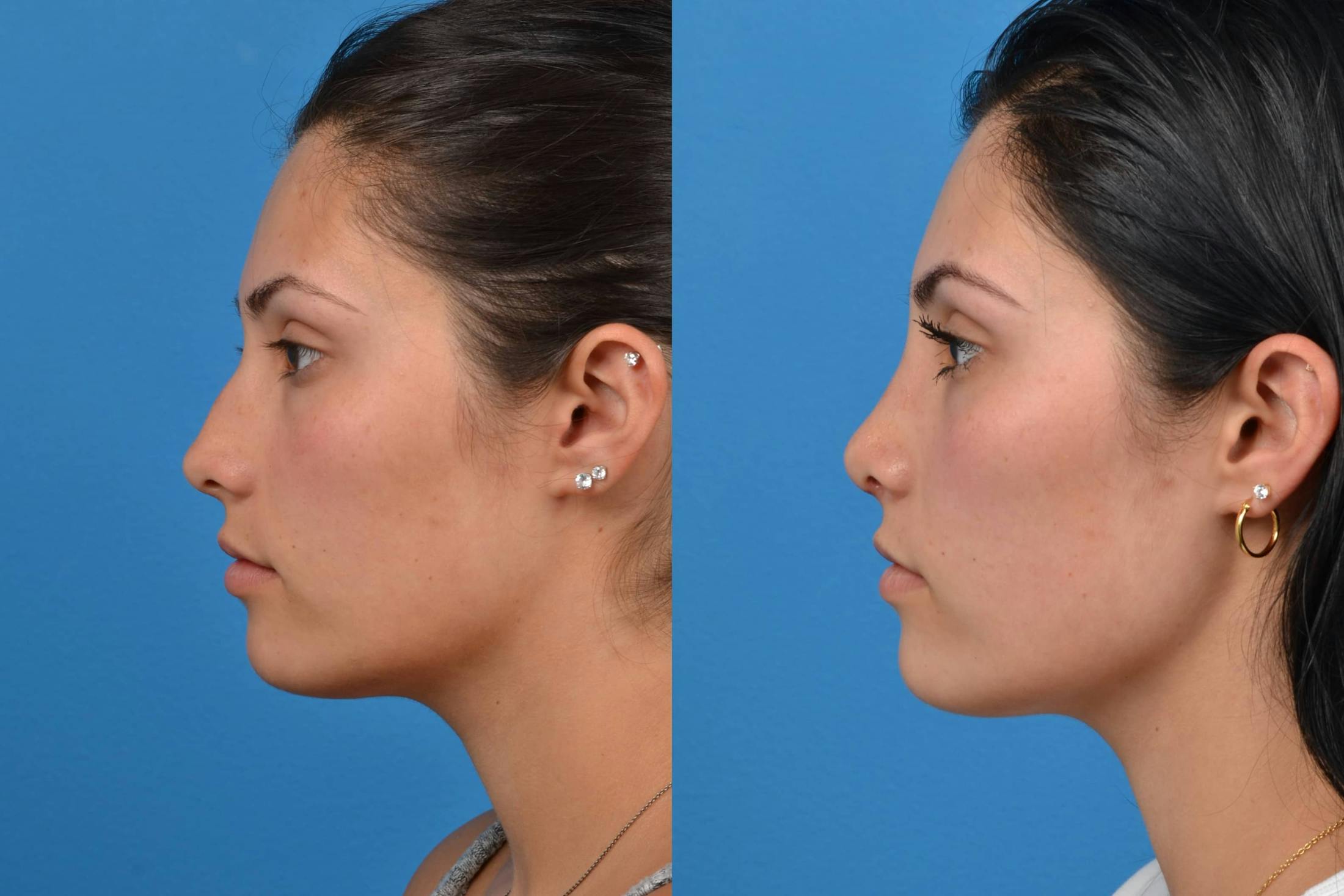 Rhinoplasty Before & After Gallery - Patient 122406554 - Image 5