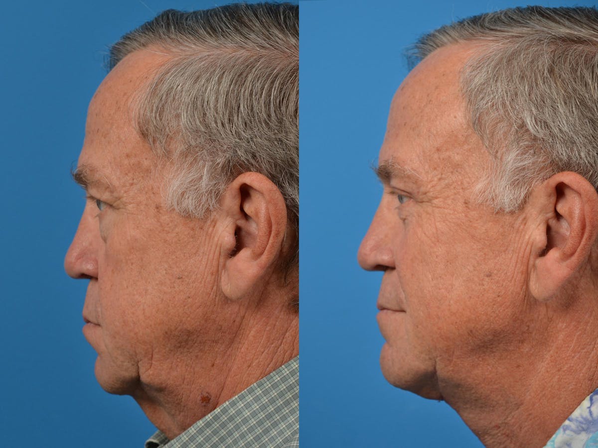 Profile Neck Lift Before & After Gallery - Patient 122406555 - Image 5