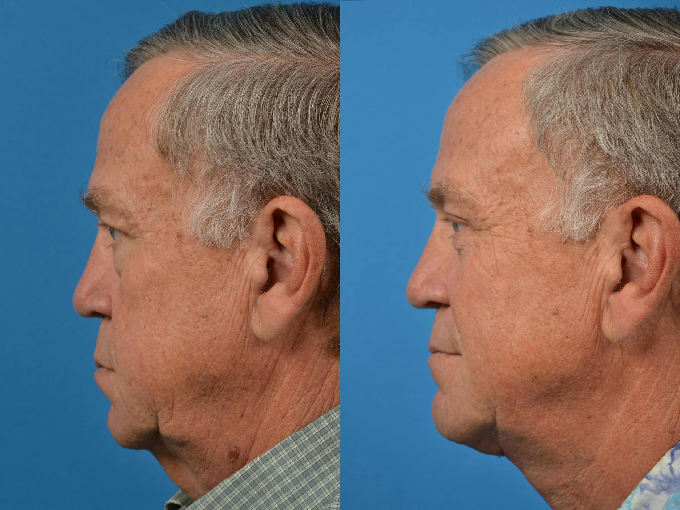 Profile Neck Lift Before & After Gallery - Patient 122406555 - Image 5