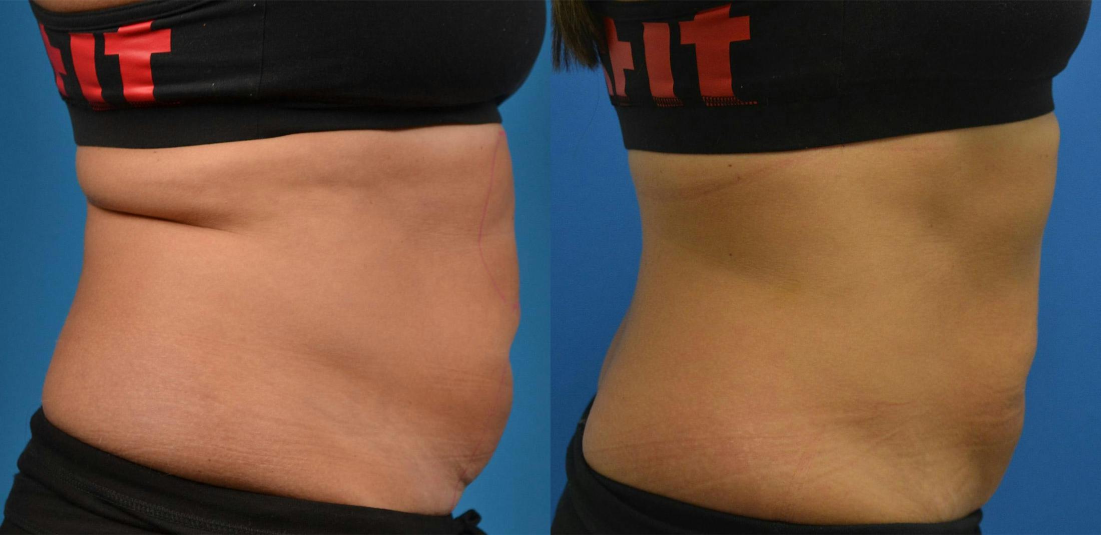 SculpSure Body Contouring Before & After Gallery - Patient 122406556 - Image 2