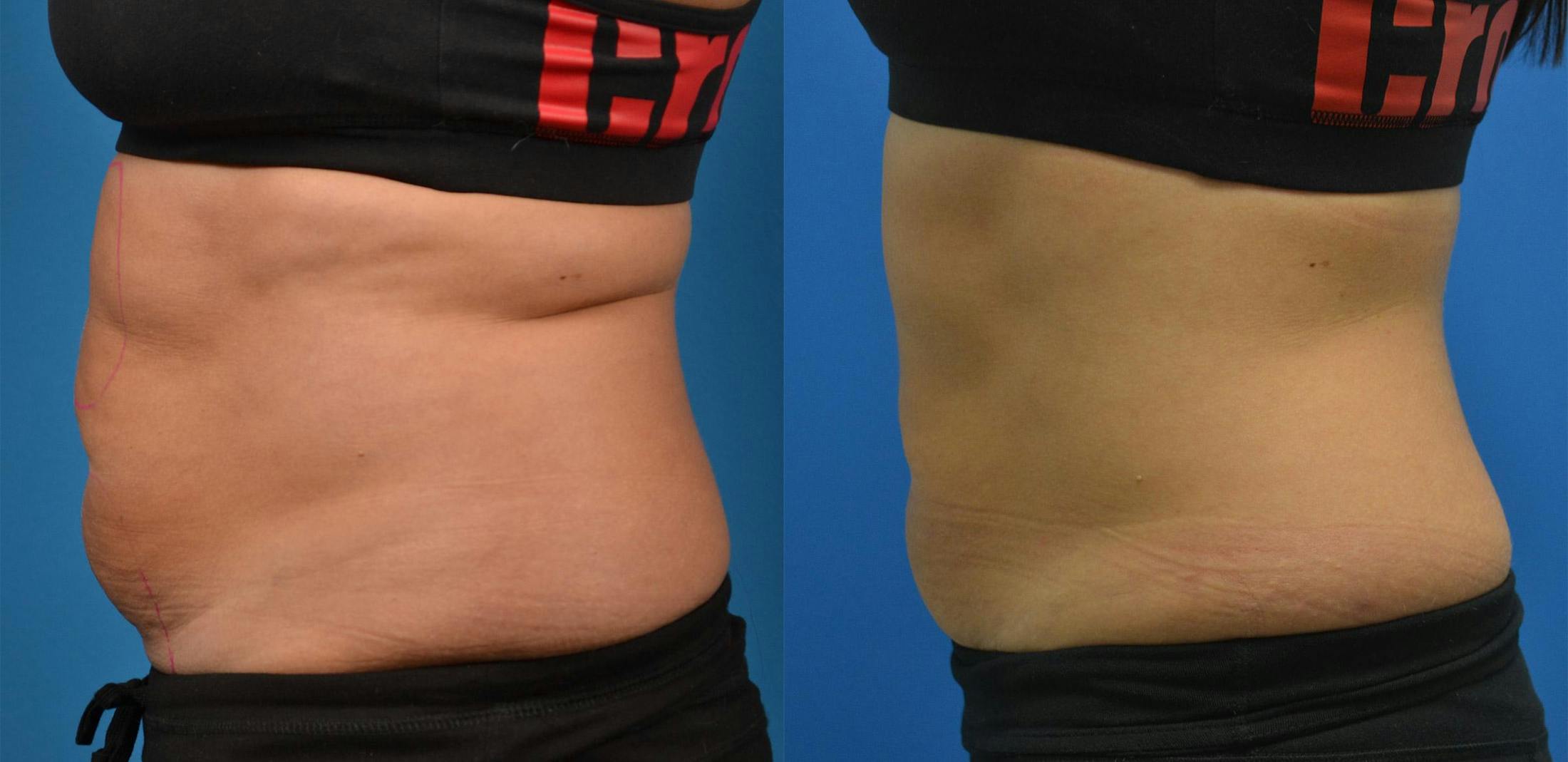 SculpSure Body Contouring Before & After Gallery - Patient 122406556 - Image 3