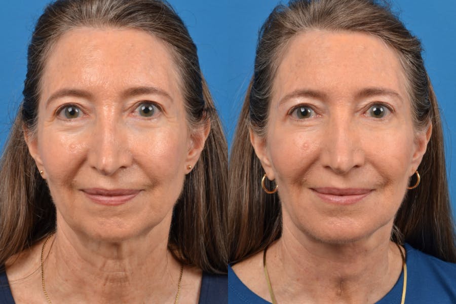Profile Neck Lift Before & After Gallery - Patient 122406557 - Image 1