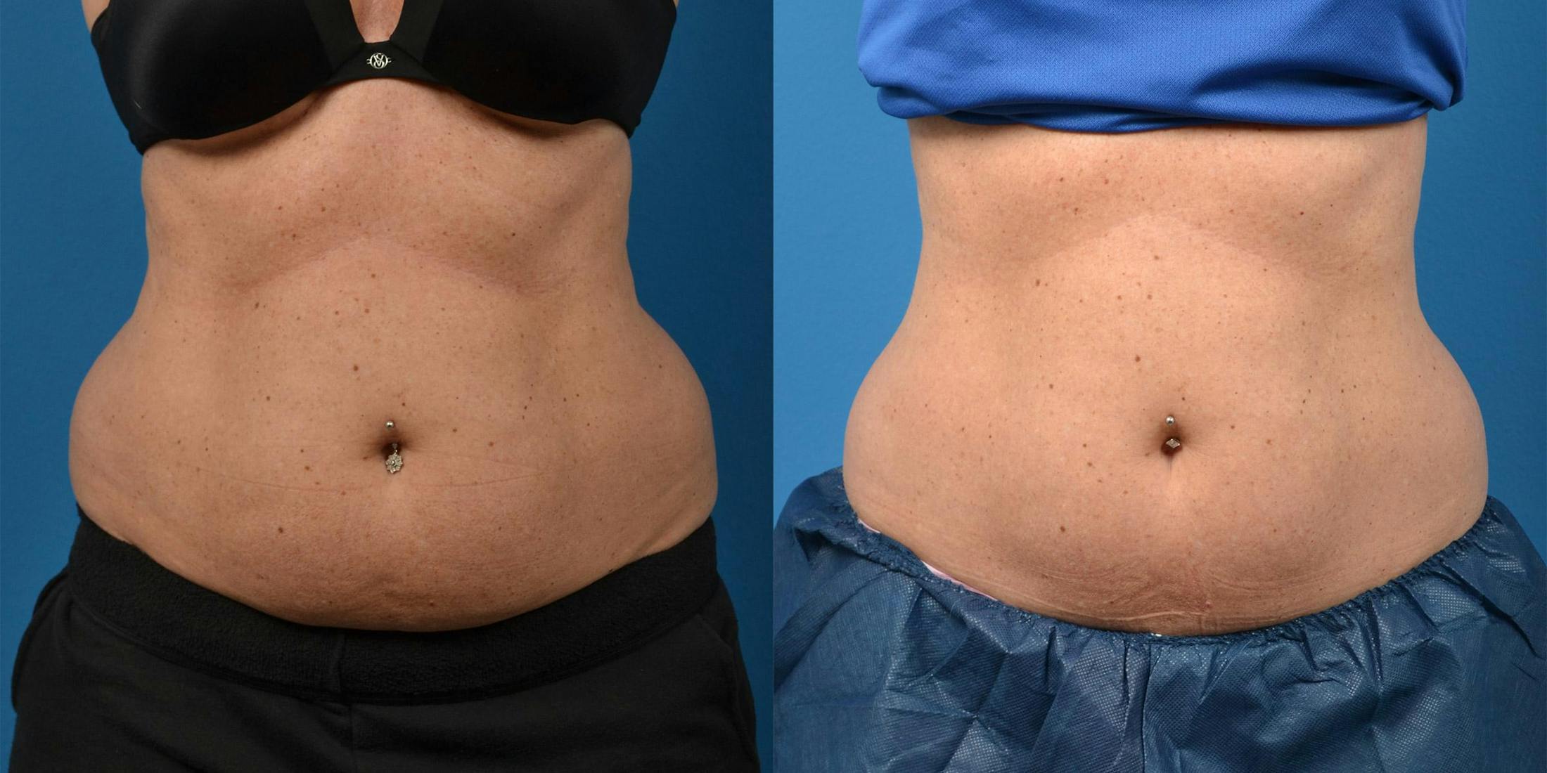 SculpSure Body Contouring Before & After Gallery - Patient 122406558 - Image 1