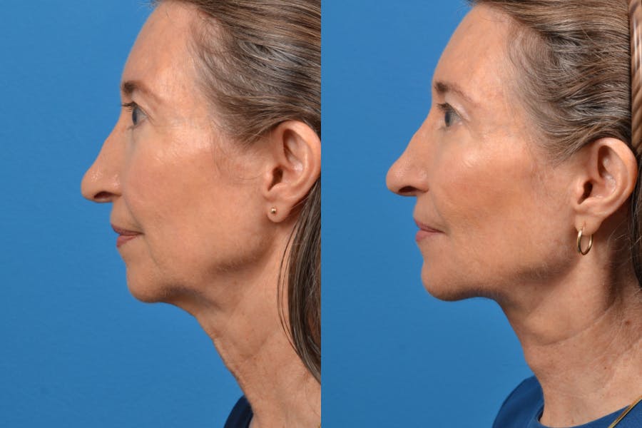 Profile Neck Lift Before & After Gallery - Patient 122406557 - Image 2