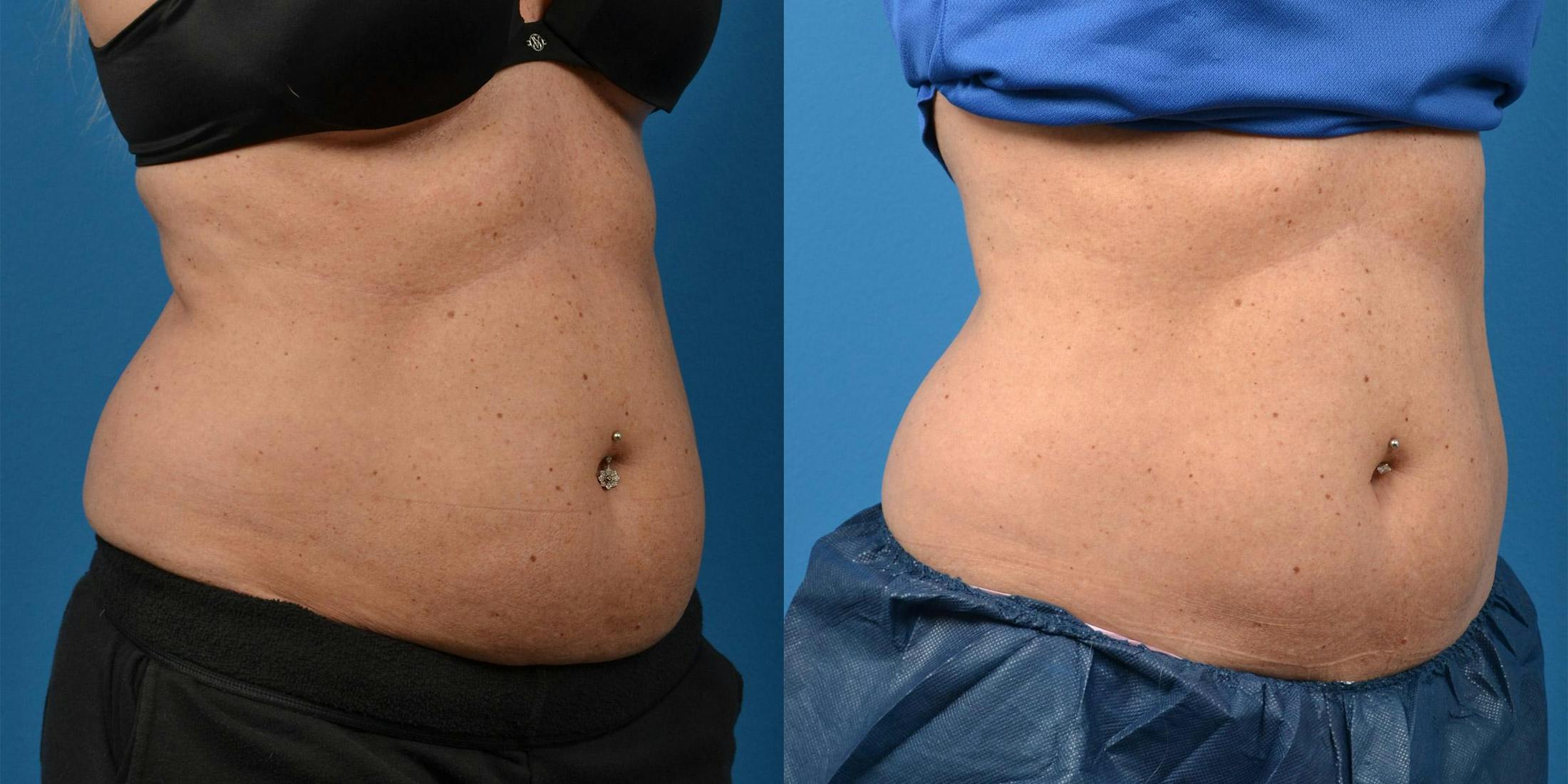 SculpSure Body Contouring Before & After Gallery - Patient 122406558 - Image 2