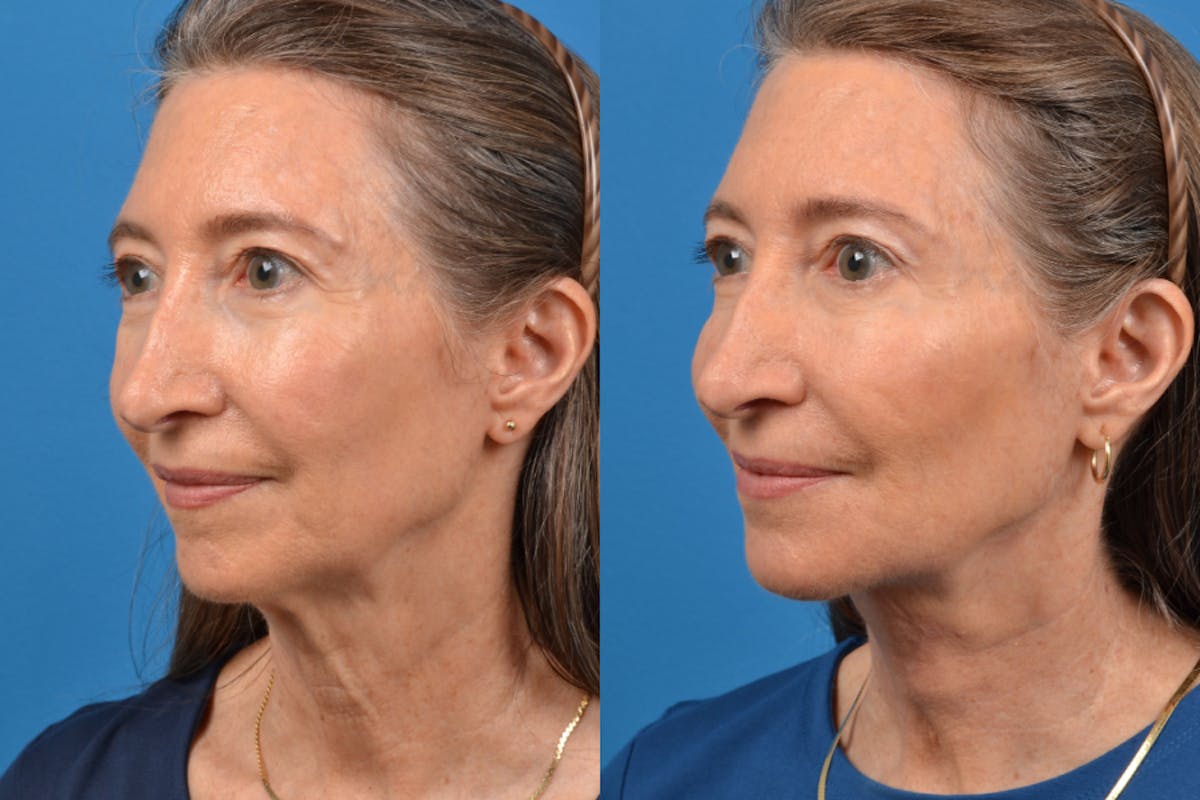 Profile Neck Lift Before & After Gallery - Patient 122406557 - Image 3