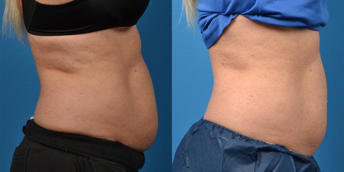 SculpSure Body Contouring Before & After Gallery - Patient 122406558 - Image 3