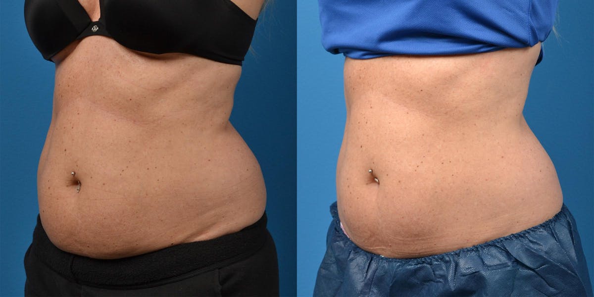 SculpSure Body Contouring Before & After Gallery - Patient 122406558 - Image 4