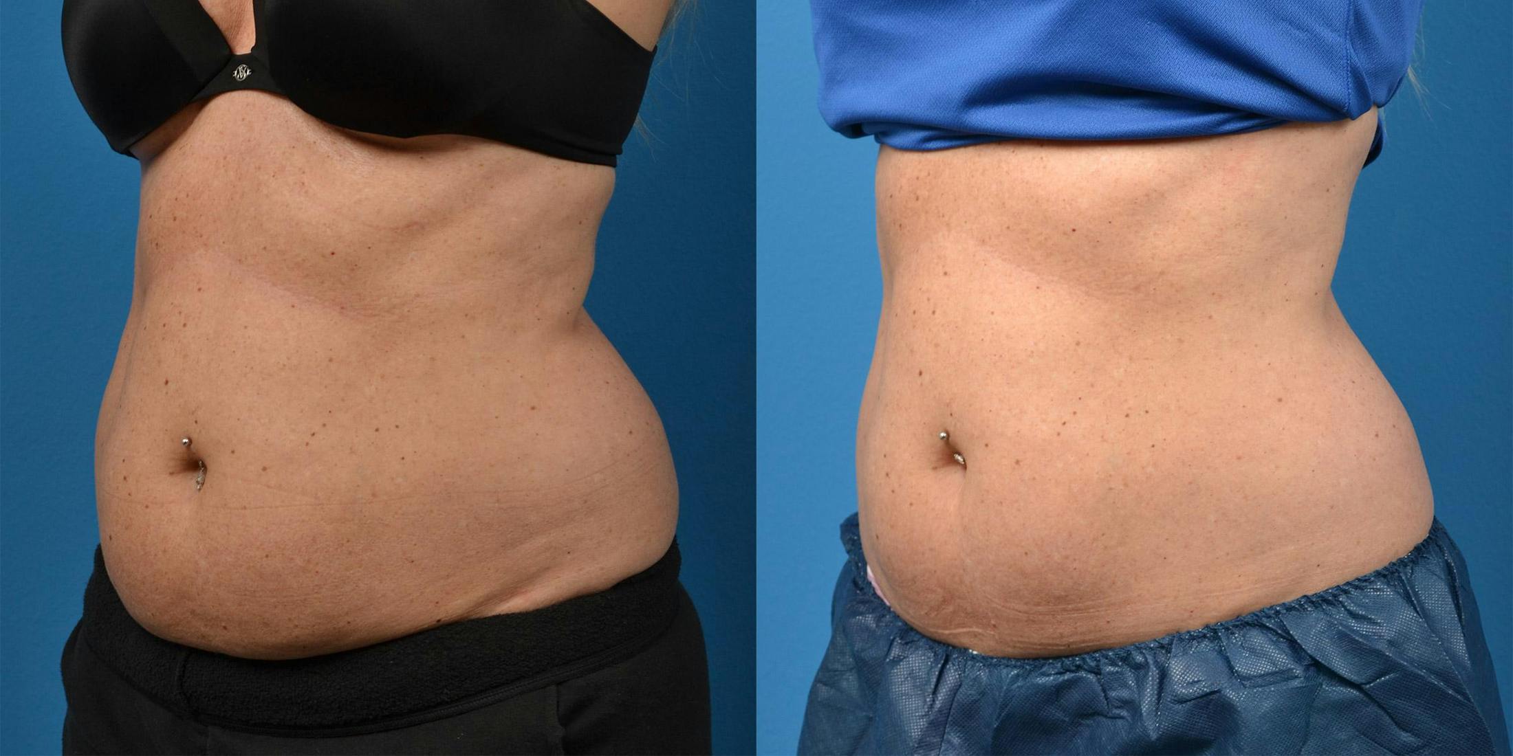 SculpSure Body Contouring Before & After Gallery - Patient 122406558 - Image 4
