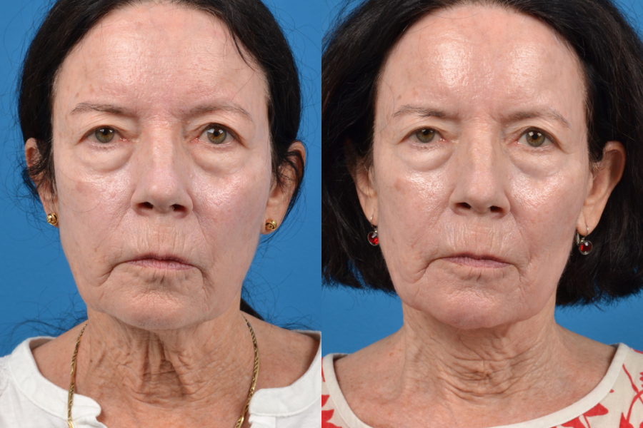 Profile Neck Lift Before & After Gallery - Patient 122406559 - Image 1