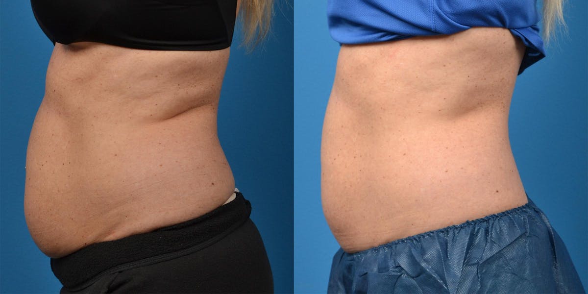 SculpSure Body Contouring Before & After Gallery - Patient 122406558 - Image 5