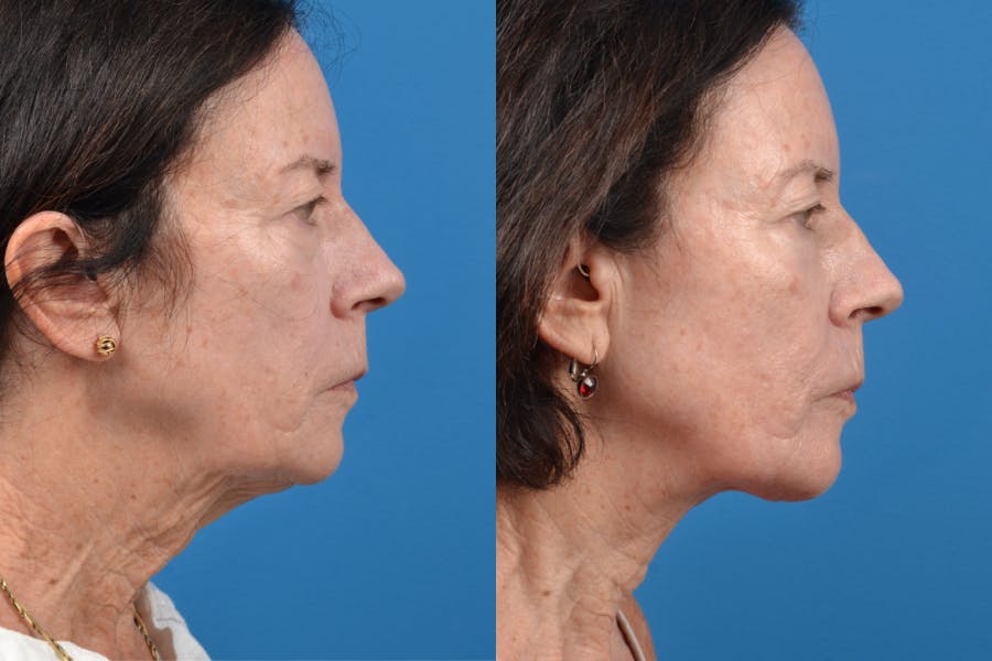 Profile Neck Lift Before & After Gallery - Patient 122406559 - Image 2