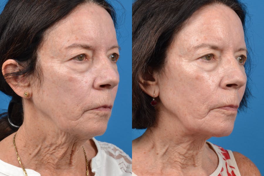 Profile Neck Lift Before & After Gallery - Patient 122406559 - Image 3