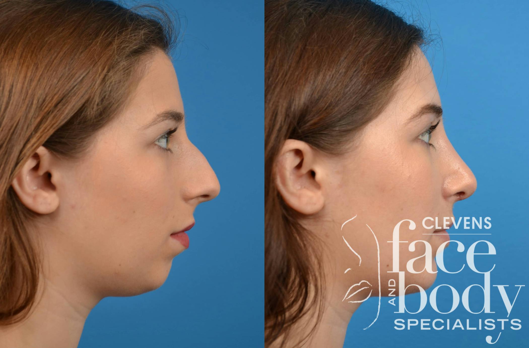 Rhinoplasty Procedure