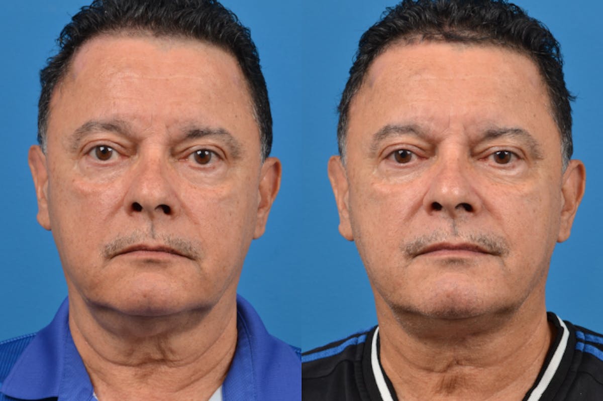 Profile Neck Lift Before & After Gallery - Patient 122406562 - Image 1