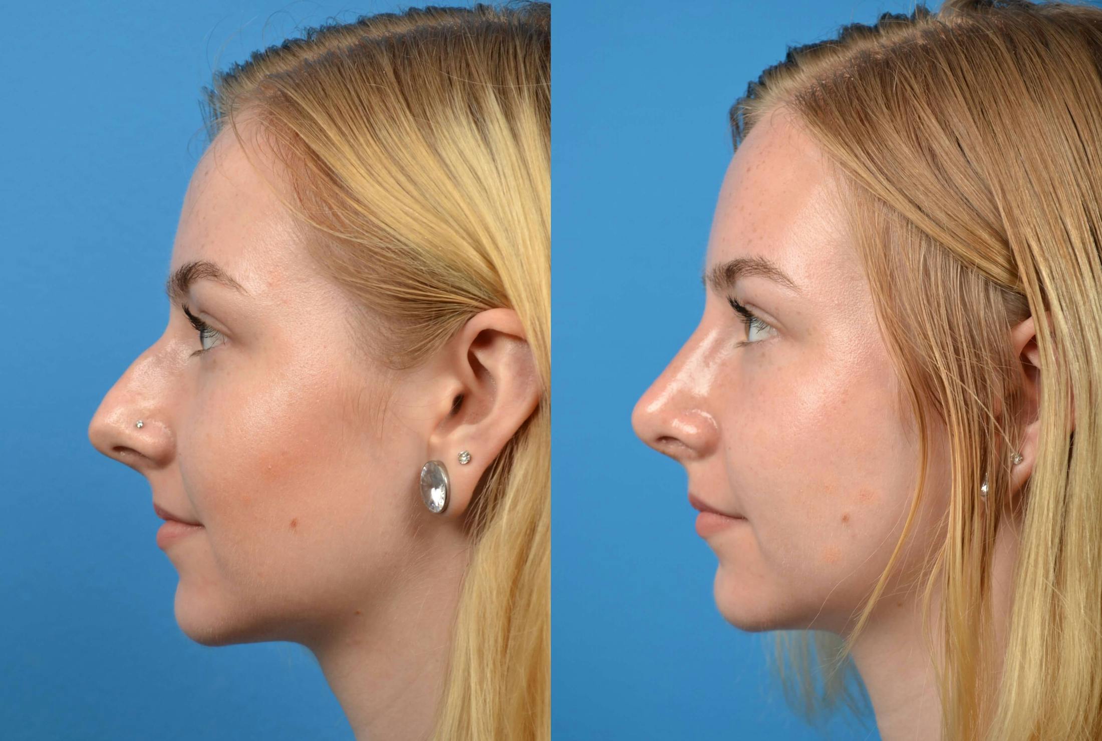 Rhinoplasty Before & After Gallery - Patient 122406563 - Image 1