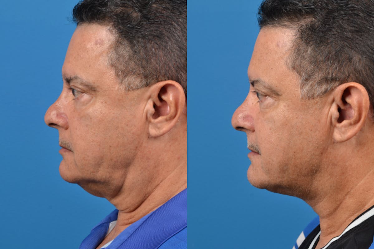 Profile Neck Lift Before & After Gallery - Patient 122406562 - Image 2