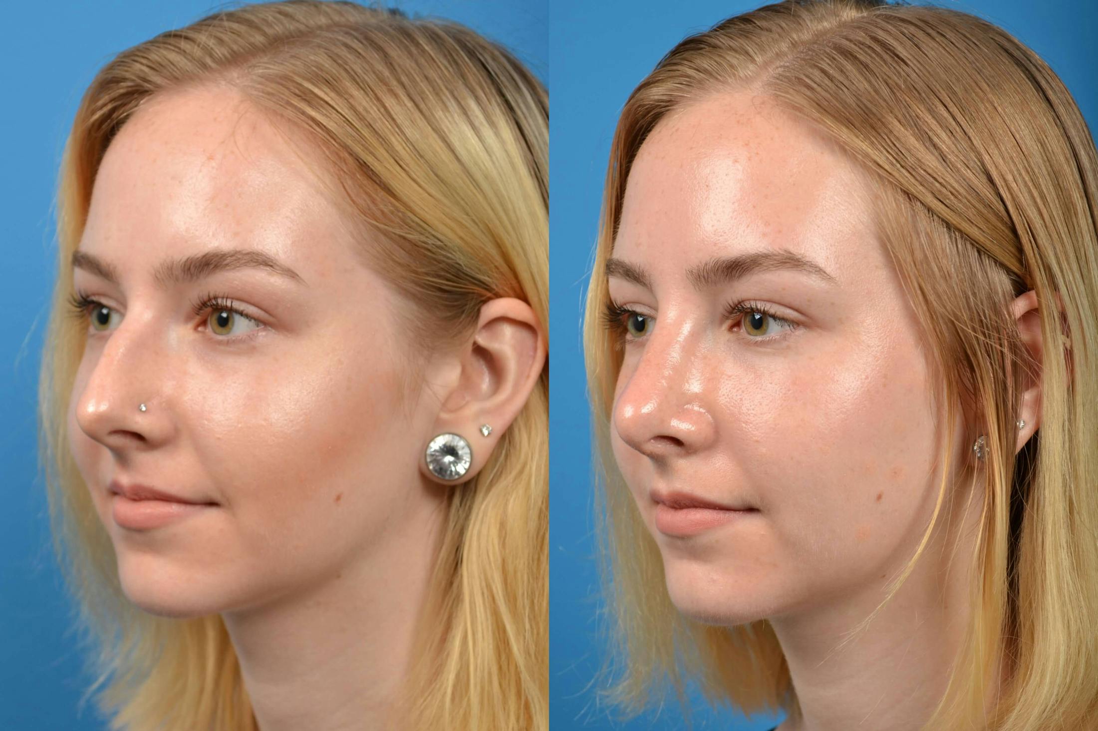 Rhinoplasty Before & After Gallery - Patient 122406563 - Image 2