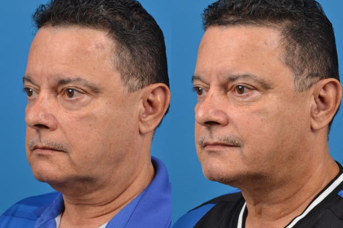 Profile Neck Lift Before & After Gallery - Patient 122406562 - Image 3