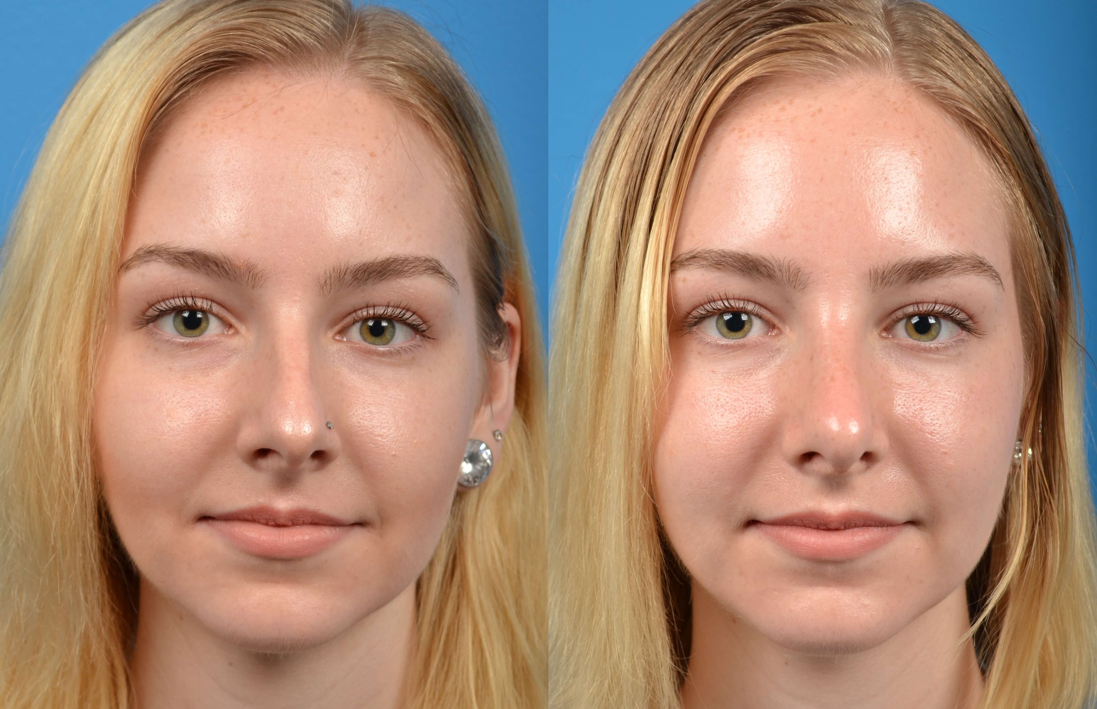 Rhinoplasty Before & After Gallery - Patient 122406563 - Image 3