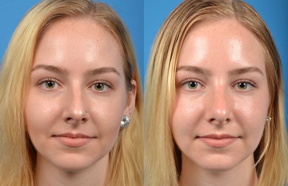 Rhinoplasty Before & After Gallery - Patient 122406563 - Image 3