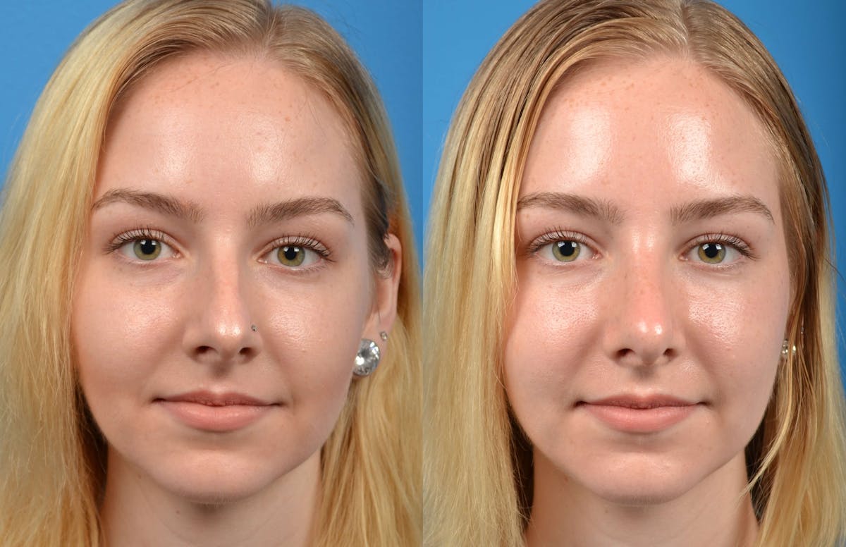 Rhinoplasty Before & After Gallery - Patient 122406563 - Image 3