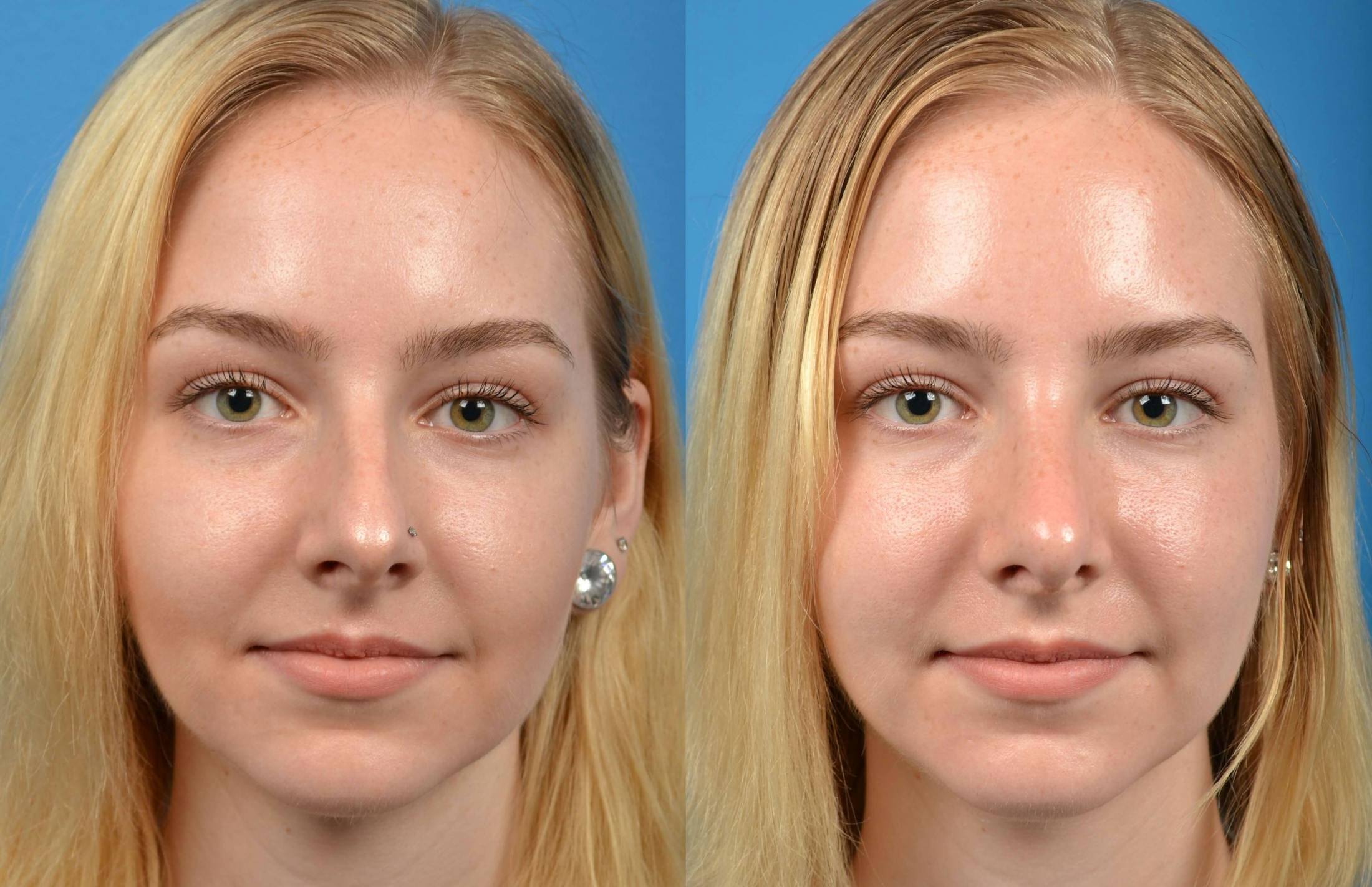Rhinoplasty Before & After Gallery - Patient 122406563 - Image 3