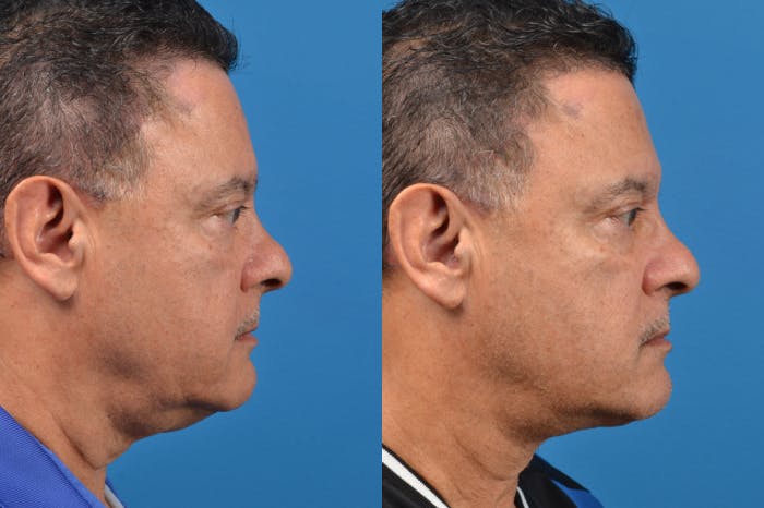 Profile Neck Lift Before & After Gallery - Patient 122406562 - Image 4