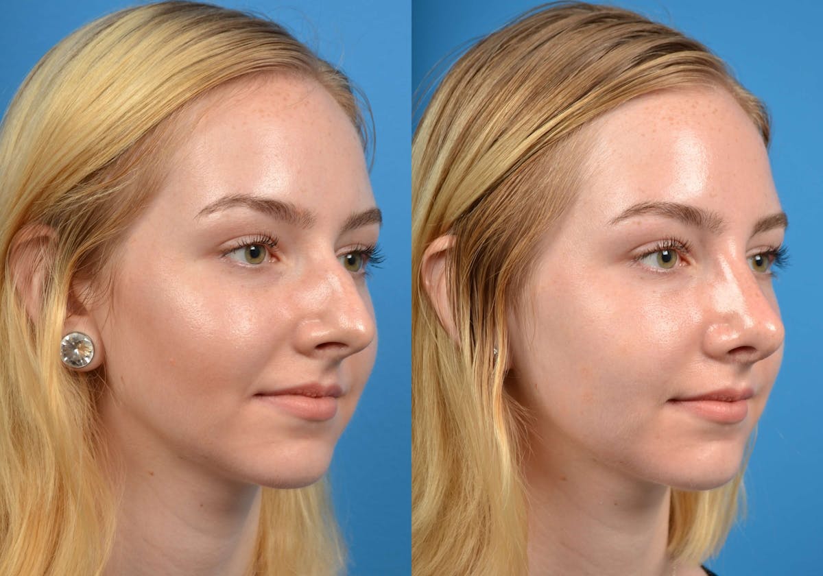 Rhinoplasty Before & After Gallery - Patient 122406563 - Image 4