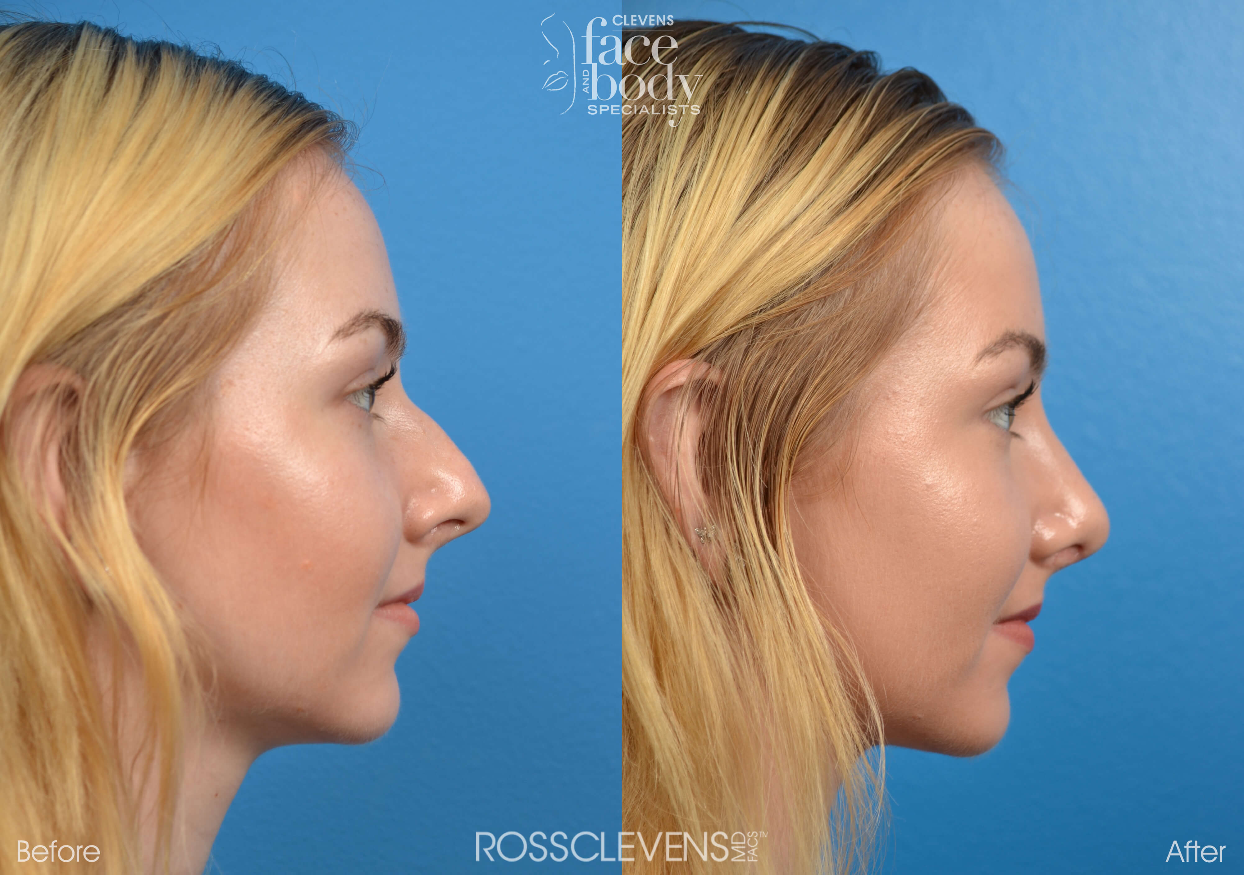 Rhinoplasty Before & After Gallery - Patient 122406563 - Image 5