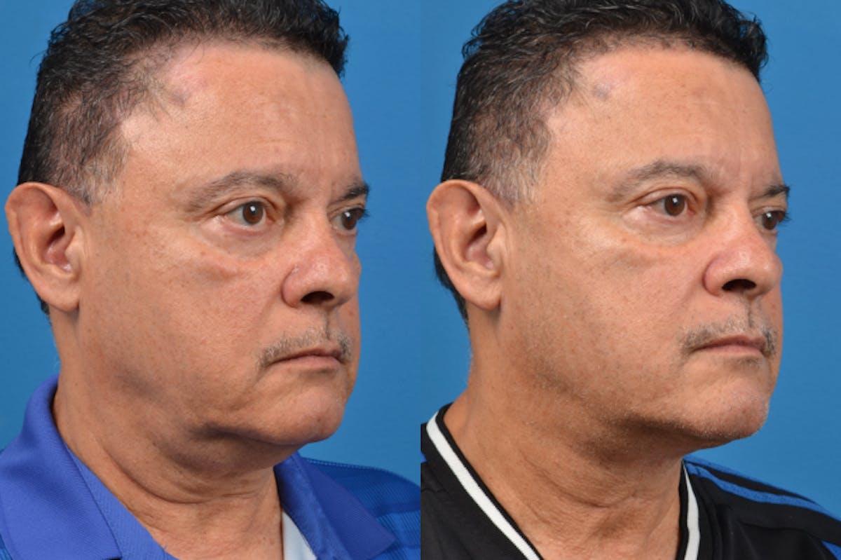 Profile Neck Lift Before & After Gallery - Patient 122406562 - Image 5