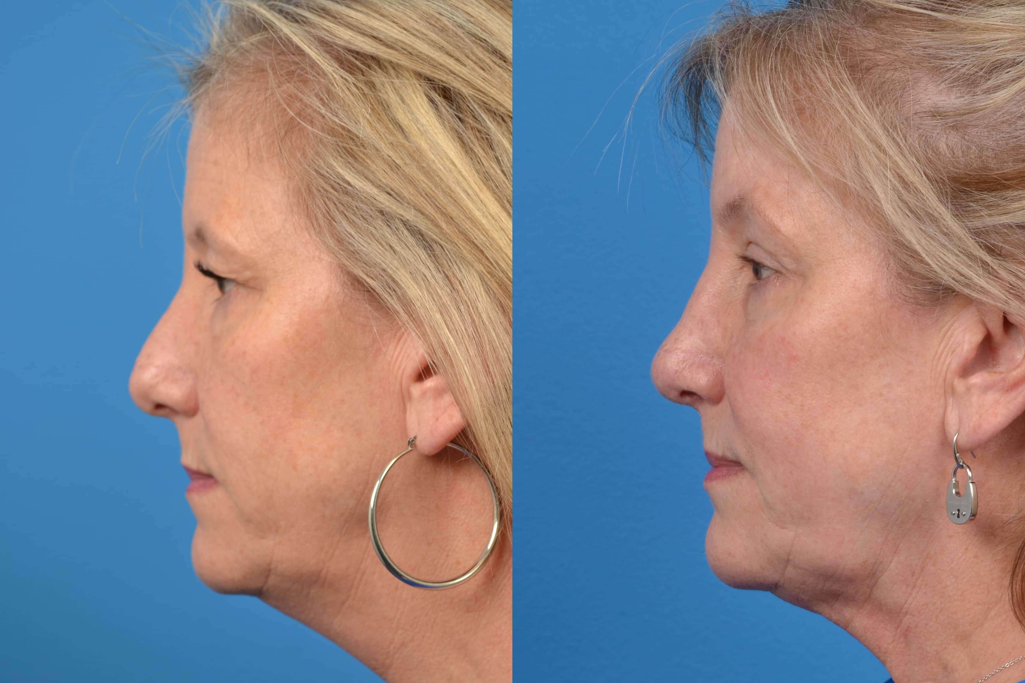 Rhinoplasty Before & After Gallery - Patient 122406565 - Image 1