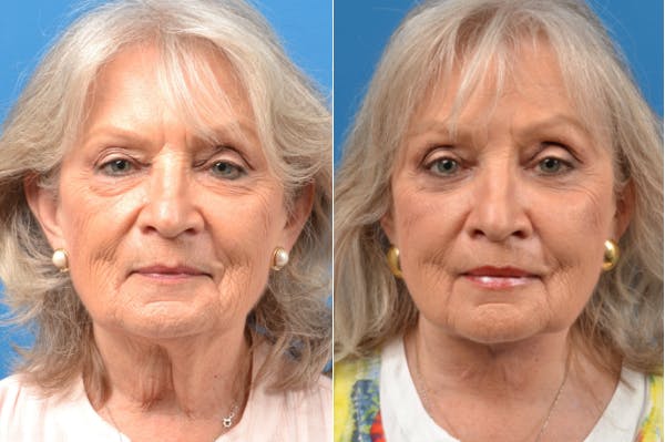 Profile Neck Lift Before & After Gallery - Patient 122406566 - Image 1