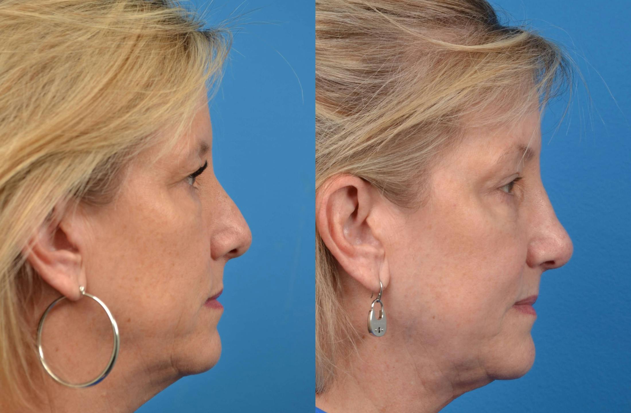 Rhinoplasty Before & After Gallery - Patient 122406565 - Image 5