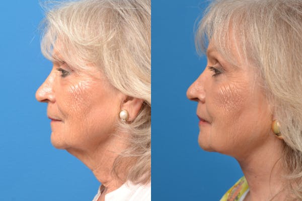 Profile Neck Lift Before & After Gallery - Patient 122406566 - Image 2