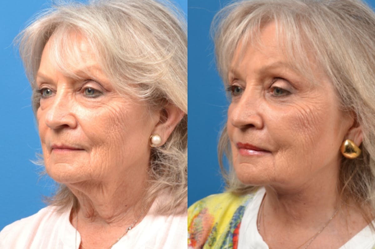 Profile Neck Lift Before & After Gallery - Patient 122406566 - Image 3