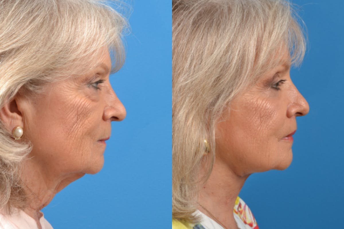 Profile Neck Lift Before & After Gallery - Patient 122406566 - Image 4