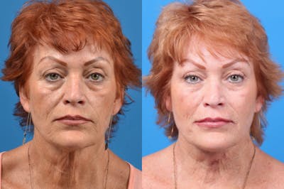 Profile Neck Lift Before & After Gallery - Patient 122406567 - Image 1