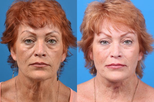 Profile Neck Lift Before & After Gallery - Patient 122406567 - Image 1
