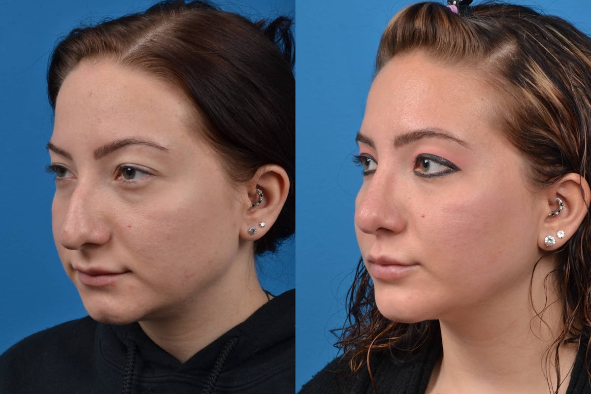 Rhinoplasty Before & After Gallery - Patient 122406568 - Image 4