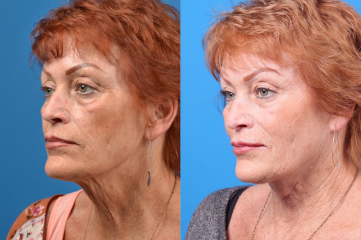 Profile Neck Lift Before & After Gallery - Patient 122406567 - Image 2